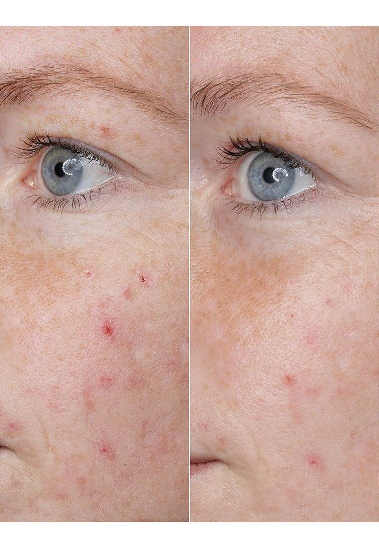 BABOR BABOR HYALURONIC ACID AMPOULE - Serum zollfrei